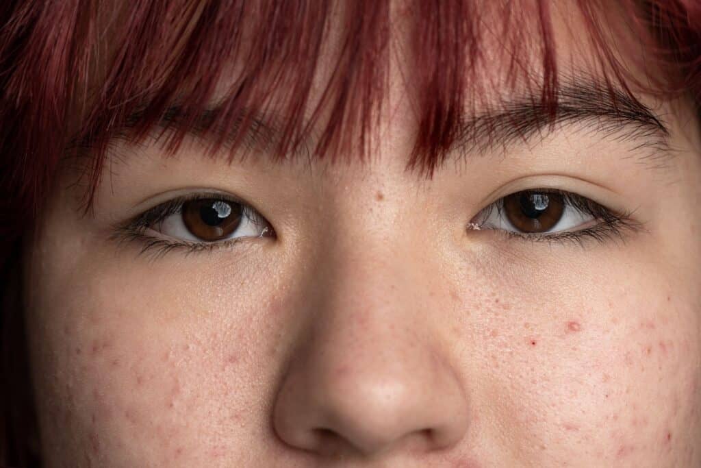 📸 適合與不適合鉑金皮秒的族群不同,需由醫師依膚況、敏感度與治療需求專業評估。